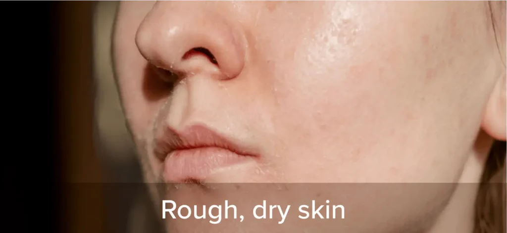 Rough, dry skin