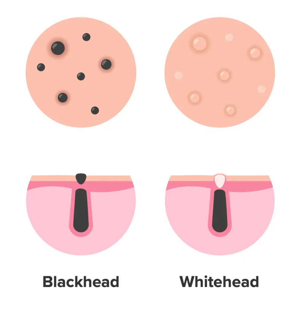 Blackhead Whitehead
