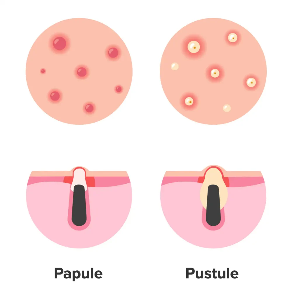 Papule Pustule