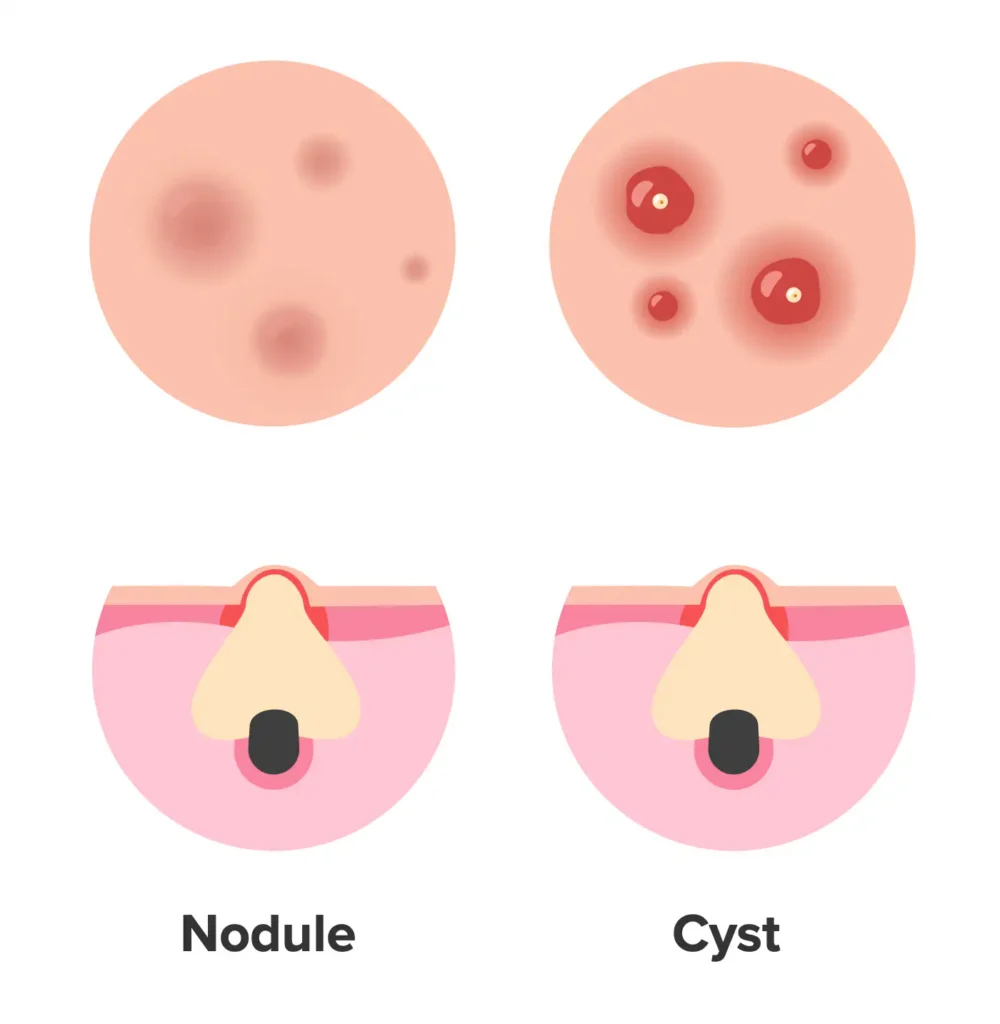 Module Cyst