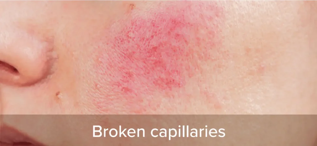 Broken capillaries