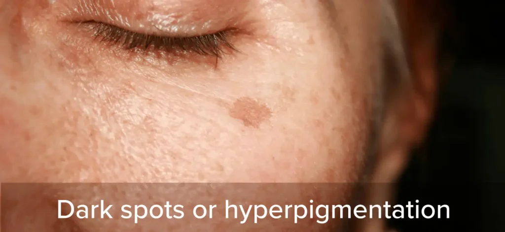Dark spots or hyperpigmentation