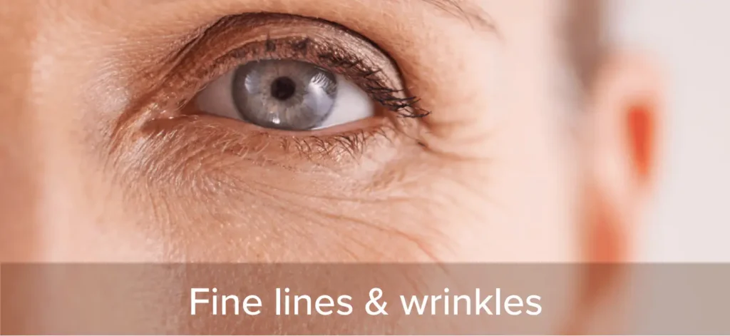 Fine lines and wrinkles