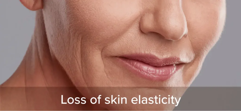 loss of skin elasticity