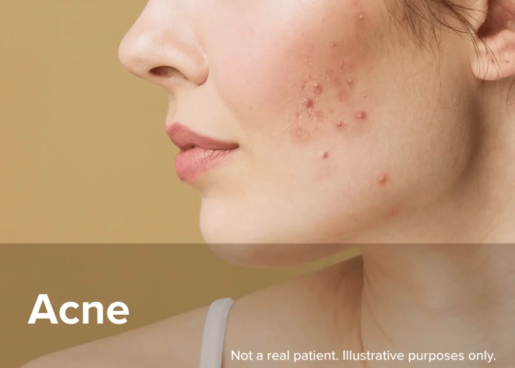 Retrieve Helps with Acne