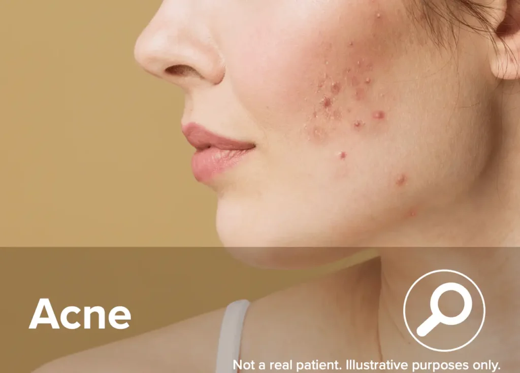 ReTrieve restores skin and improves Acne
